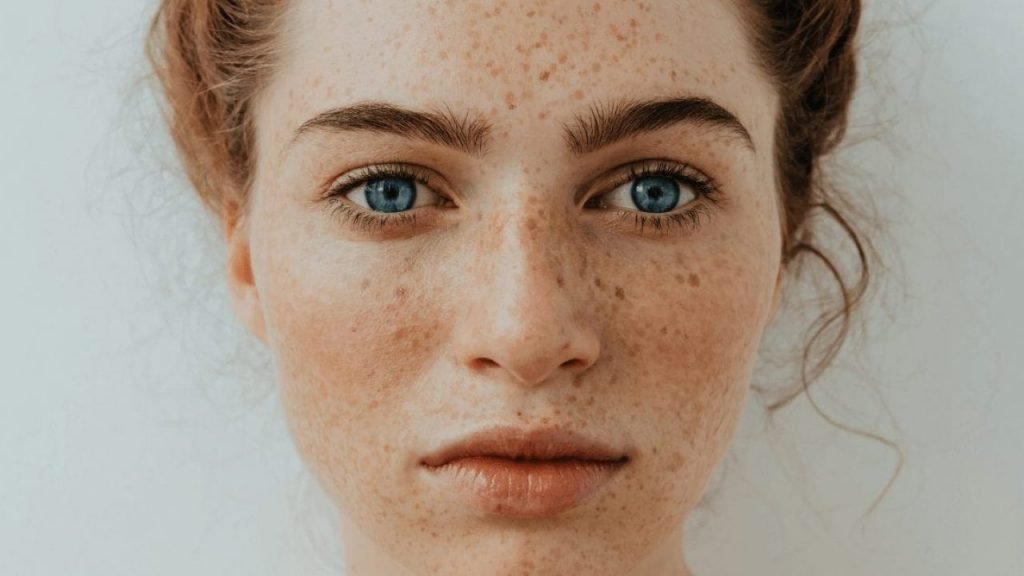 What are Freckles
