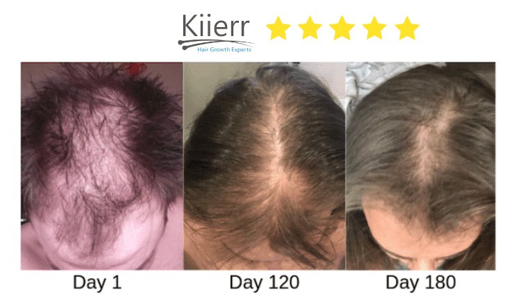 Kiierr laser hair growth cap